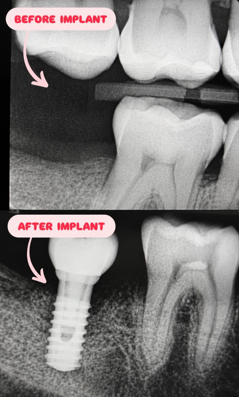 Wisdom Tooth Removal
